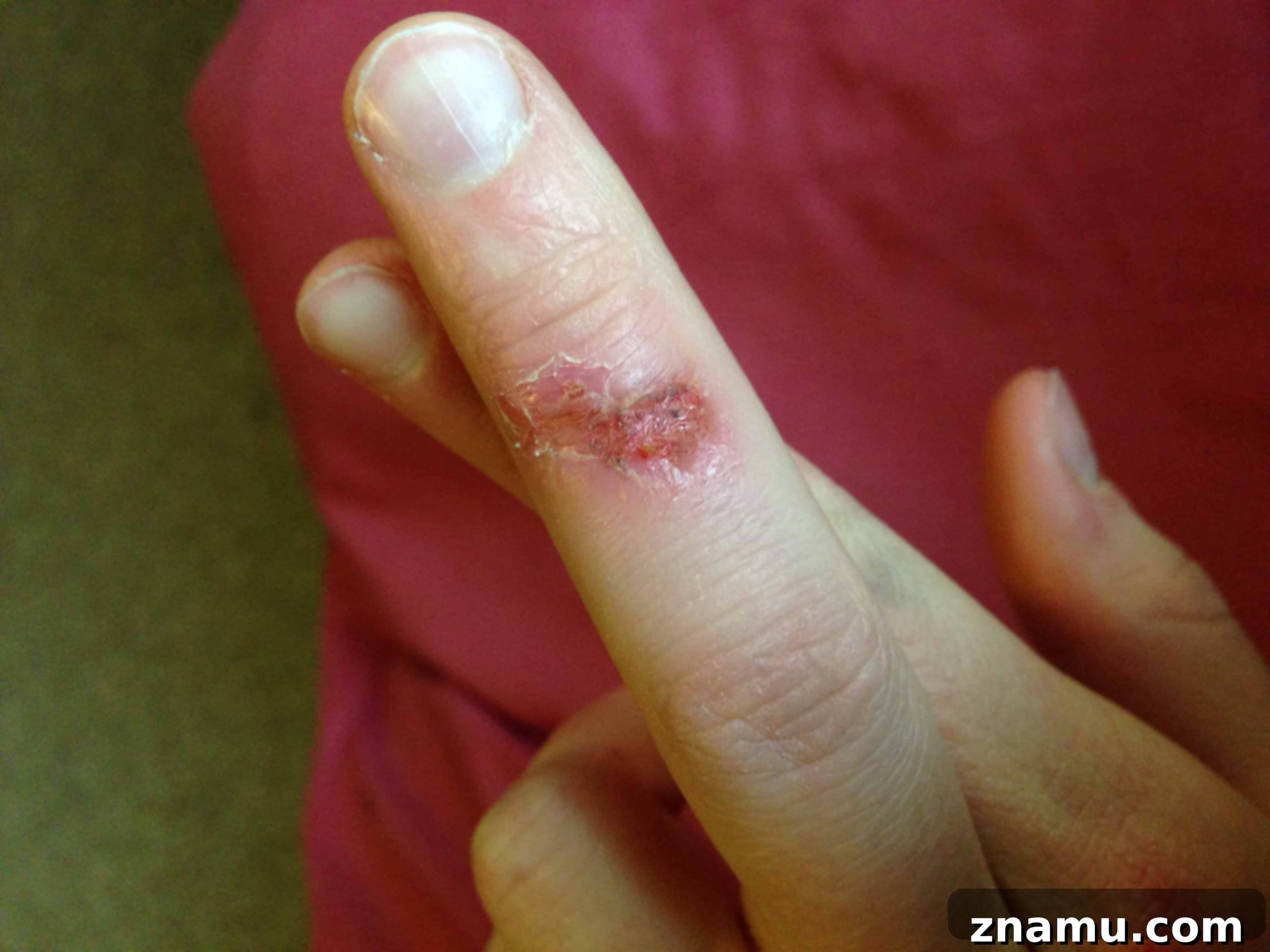 Kitchen Secrets: The Ongoing Culinary Quest 27 Steam burn on chef's arm, a common kitchen injury